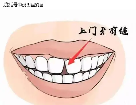 牙齒縫隙大有什么好的方法解決？